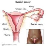 Understanding Ovarian Cancer: Risks, Symptoms, Diagnosis, and Treatment