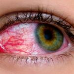 common-myths-about-pink-eye-722×406