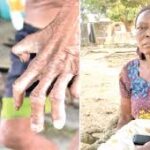 Nigerian leprosy patients miss over a year of treatment.
