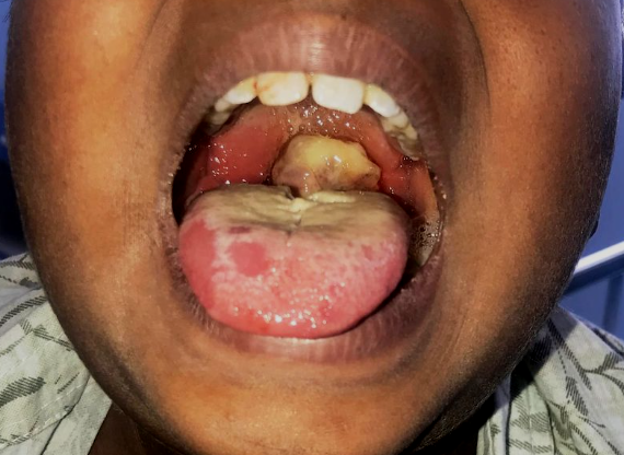 Nigeria diphtheria immunisation epidemic highlighted by a healthcare professional preparing a vaccine dosage