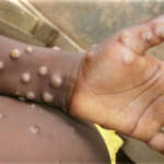 South Africa Mpox Cases Rise to 22 in Western Cape south africa mpox cases health department outbreak surveillance western cape