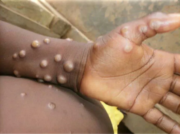 south africa mpox cases health department outbreak surveillance western cape