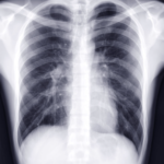 Kenya Bets on AI Chest X-Rays to Find Its Missing TB Patients kenya bets on ai - chest radiography scan for tuberculosis