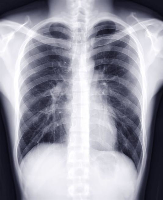 kenya bets on ai - chest radiography scan for tuberculosis