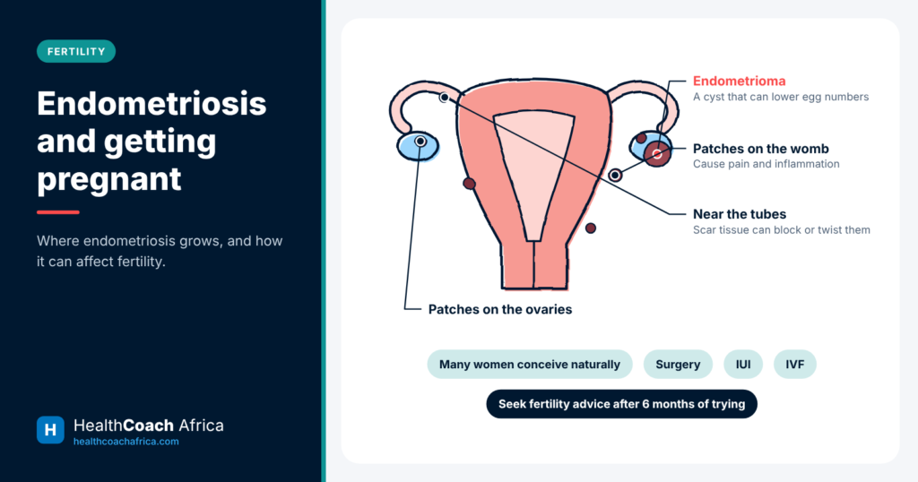 Pelvic diagram showing endometriosis patches on ovaries and tubes, explaining endometriosis and getting pregnant