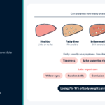 Fatty Liver Disease Symptoms: The Silent Condition You Can Reverse Liver diagram showing four stages from healthy liver to cirrhosis with common fatty liver disease symptoms