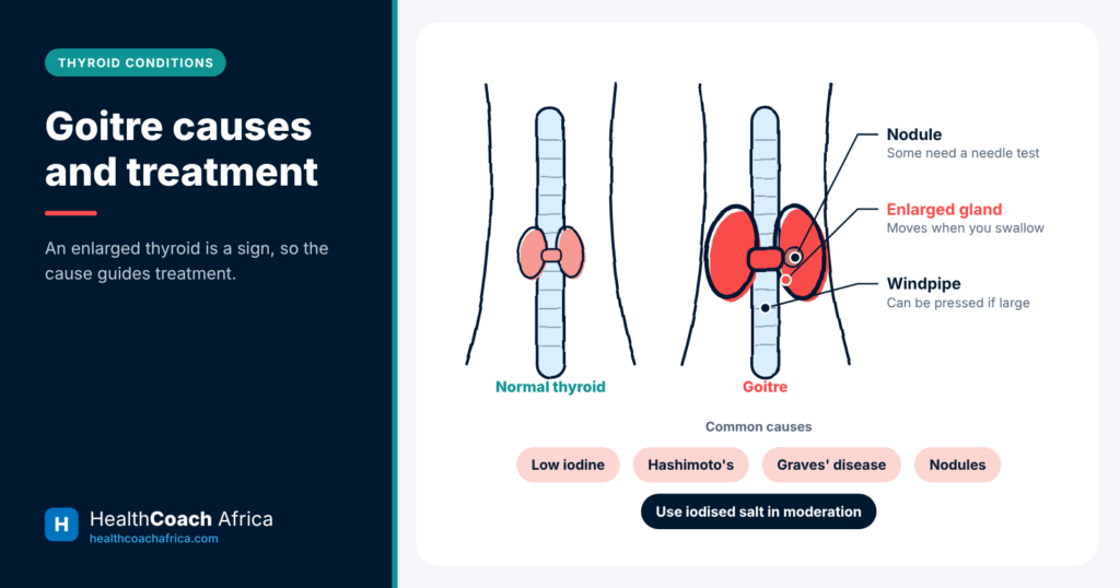 Neck diagram comparing a normal thyroid with an enlarged gland to explain goitre causes and treatment