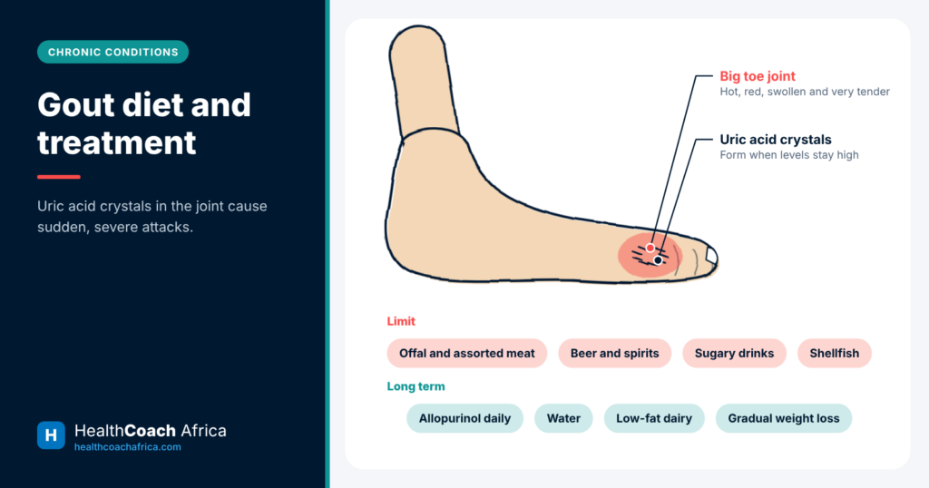 Foot diagram showing uric acid crystals in the big toe with key steps in gout diet and treatment