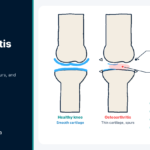 Knee Osteoarthritis Pain Relief: What Works and What to Avoid Knee joint diagram comparing healthy and worn cartilage, with options for knee osteoarthritis pain relief