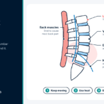 Lower Back Pain Relief: What Works and When to Worry Side view diagram of the lumbar spine, discs and nerves, explaining lower back pain relief