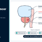Prostate Cancer in Nigeria: Signs, Testing and Treatment Diagram of the prostate below the bladder explaining PSA testing and prostate cancer in Nigeria