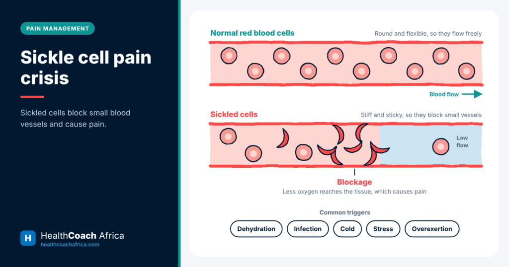 Diagram of normal and sickled red blood cells in a vessel during a sickle cell pain crisis