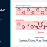Sickle Cell Pain Crisis: Triggers, Home Care and Red Flags Diagram of normal and sickled red blood cells in a vessel during a sickle cell pain crisis