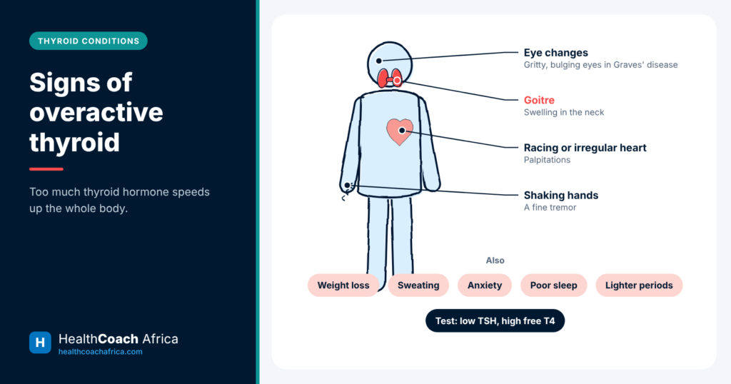 Body diagram labelling the signs of overactive thyroid, including racing heart, tremor, weight loss and eye changes