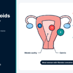 Uterine Fibroids and Fertility: What Every Woman Should Know Womb diagram showing three fibroid positions, explaining uterine fibroids and fertility