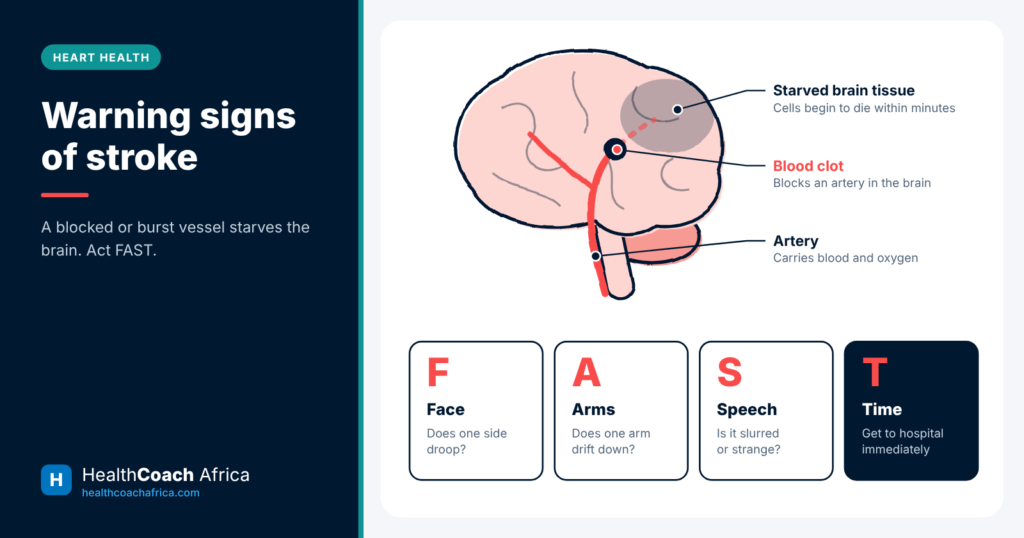 Brain diagram with a clot blocking an artery and the FAST test for the warning signs of stroke