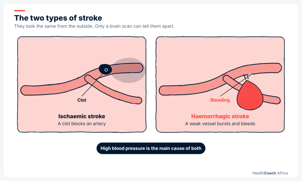Brain diagram with a clot blocking an artery and the FAST test for the warning signs of stroke
